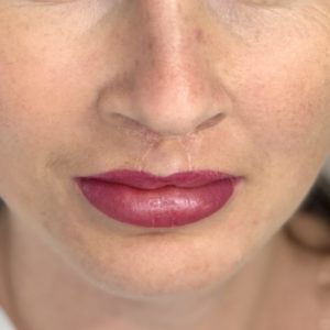 Pigmentacja medyczna ust po obustronnym rozszczepie wargi