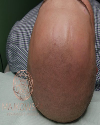 Mikropigmentacja skóry głowy Majkowska